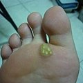 10幾年的尋常疣*魚鱗贅*足底疣*.......冷凍治療後皮膚腫脹疼痛..腳底明顯的看到6顆疣..無法走路..