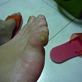 第一次冷凍疼痛腫脹的小拇指~*足底疣*