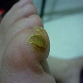 持續擦青草讓它自然萎縮剝落