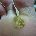 疣跟皮膚開始漸漸剝離了