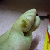 疣體已經整個都自然掀開脫落