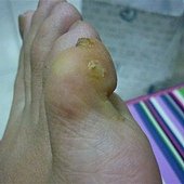 全部脫落但皮膚裡面摸起來還有硬塊，竟然還有潛藏另一個疣根在裡面，所以還要再繼續擦抹