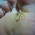 第一層皮已經脫落...起先看見裡面還有3顆疣..再繼續擦藥...