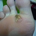 第一層皮已經脫落...起先看見裡面還有疣..再繼續擦藥...漸漸掉了...