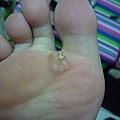 還沒有好喔....第一層皮雖然已經完全脫落...但裡面還有好幾顆疣..皮膚有硬塊..再要再繼續擦藥...
