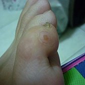 皮膚再收口恢復當中....再繼續擦藥