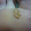 第二層疣也漸漸剝落..再繼續擦...