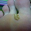 第二層疣也漸漸剝落..已經快掉了..再繼續擦...不可以強行修剪拔除..會留根在裡面有再長的疑慮...