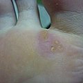 第二層疣已經剝落.但還沒好喔...硬塊明顯變色..疣根已經浮出更明顯了....再繼續擦...