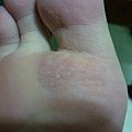 第三層疣已經剝落....疣根也已經明顯脫落了...再繼續擦.讓皮膚恢復原貌..
