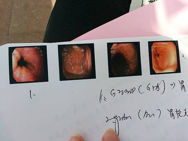 蔡明勳診所腸胃科! 照胃鏡 (潰瘍加胃逆流)