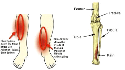 shin-splints3148505992986384817.png