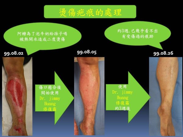 燒燙傷疤痕治療經驗分享