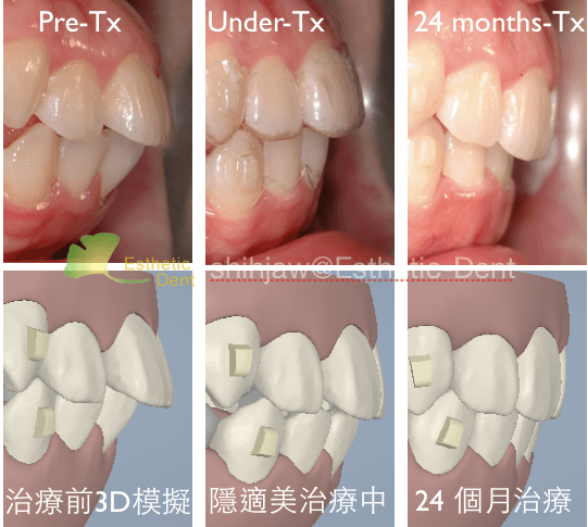 Ext-Invisalign