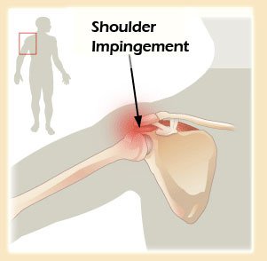 shoulder-impingement-syndrome-2.jpg