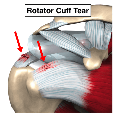 rotator-cuff-impingement-syndrome - 複製.png