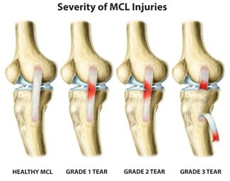 MCL-Tear-Grades.jpg