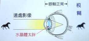 近視成因
