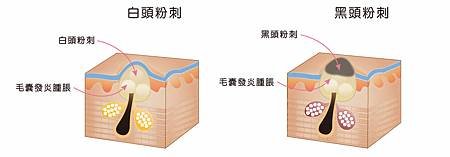 粉刺圖示