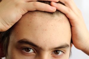 How-To-Prevent-Pimples-Due-To-Dandruff1.jpg