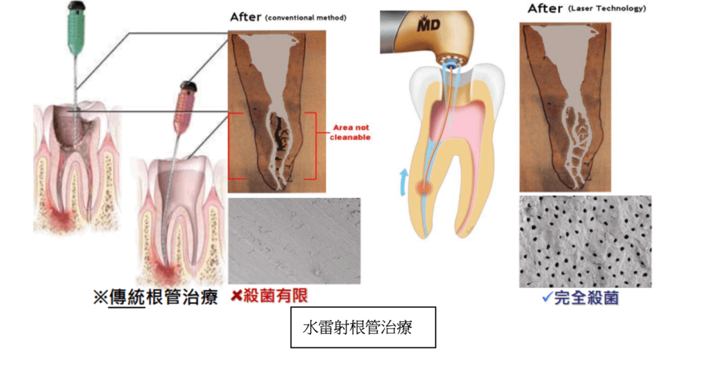「水雷射治療」水雷射治療可以運用在哪些療程