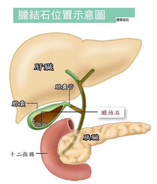 膽結石位置.jpg