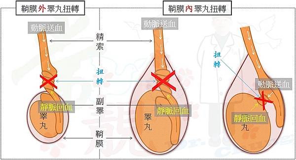 睪丸扭轉血流不良.jpg