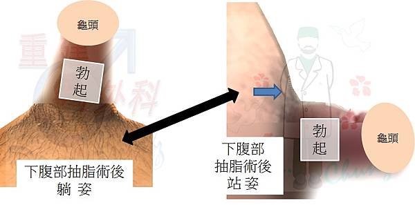 異體真皮增大的龜殼效應困擾-中篇(The turtle-sh