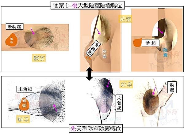 恥丘皮瓣增長-個案1-12VS正常陰莖.jpg