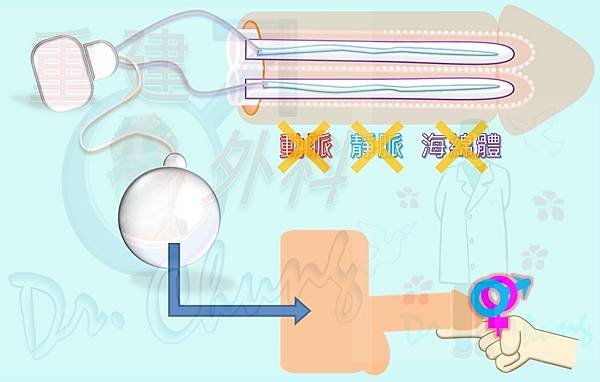 一日人工陰莖，終身人工陰莖.jpg