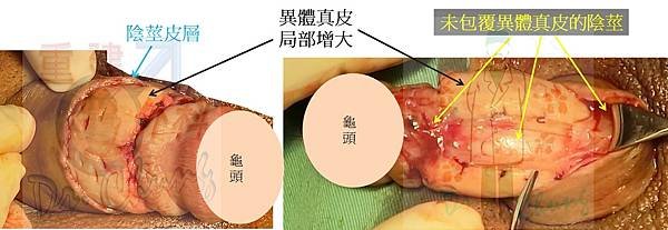 陰莖異體真皮局部增大.jpg
