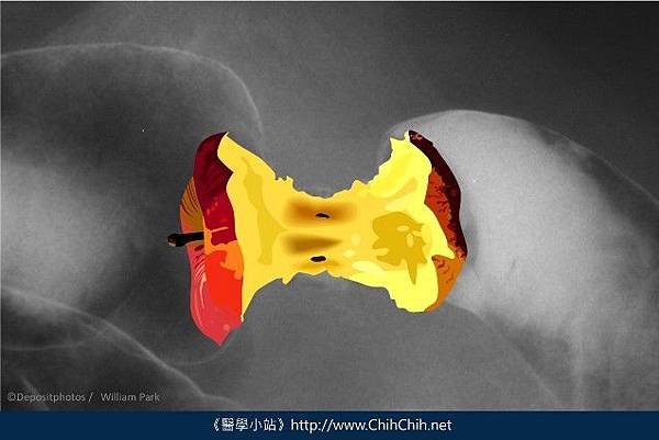 大腸癌-下消化道攝影-2.jpg