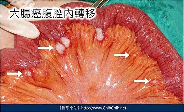 大腸癌-04.jpg