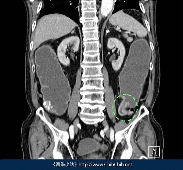 大腸癌-電腦斷層-02.jpg