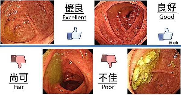 多久做一次大腸鏡，才算剛剛好？.jpg