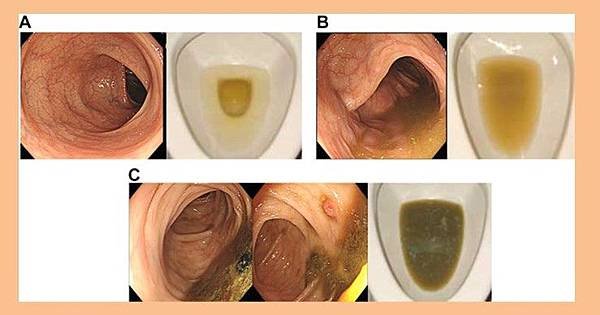 要做大腸鏡，怎樣清腸最乾淨？%20(1).jpg