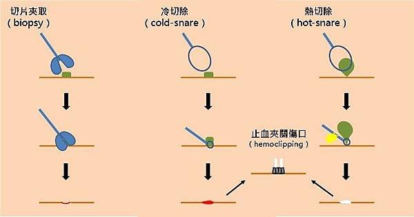 大腸息肉切除，您該知道的事-照護線上-2.jpg