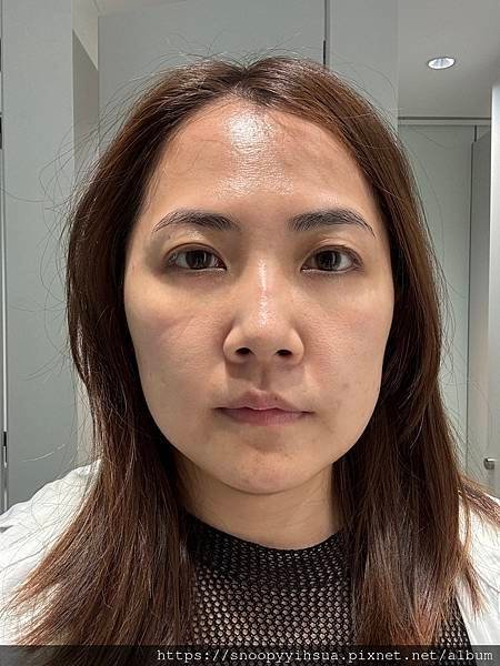 ≡醫美≡愛爾麗診所 HIPRO-S 打造完美臉部輪廓 龍捲風