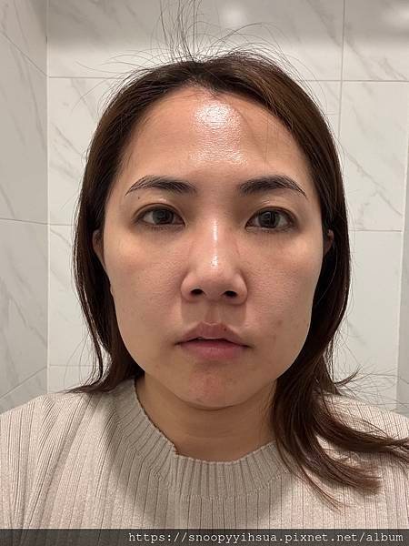 ≡醫美≡愛爾麗診所 HIPRO-S 打造完美臉部輪廓 龍捲風