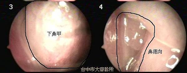 nasalpolyps