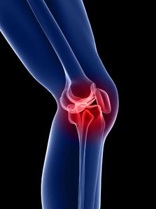 osteoarthritis-knee