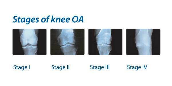 stages-of-knee