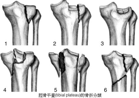 tibialplateau