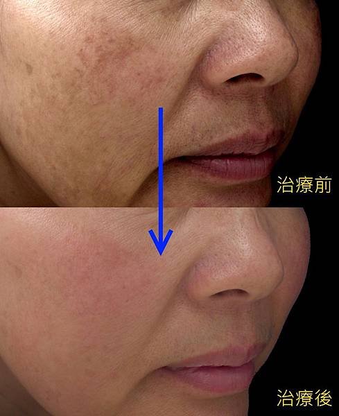 Melasma_BA.jpg