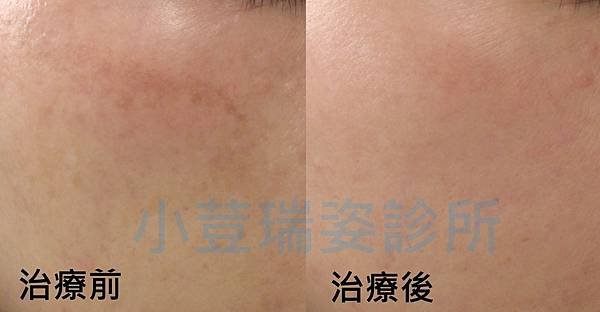 Melasma2.jpg