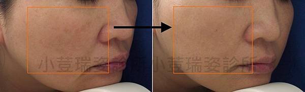 melasma3L.jpg