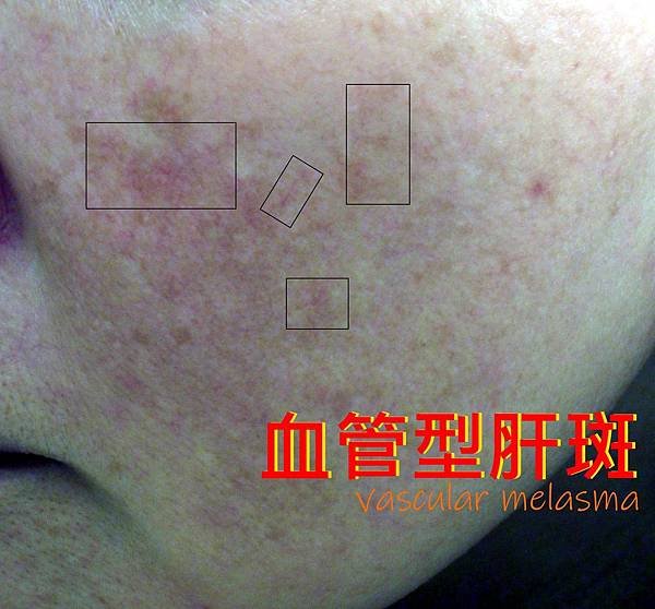 Vascular_melasma.jpg