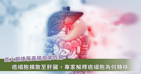 顧婕罹患直腸癌第四期！為什麼大腸癌最常轉移肝臟？【龜鹿】_龜