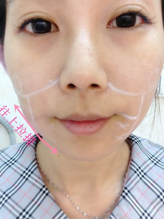 星采古亭_極線音波拉提_楊志雄醫師13