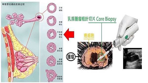 乳房腫瘤粗針切片.jpg